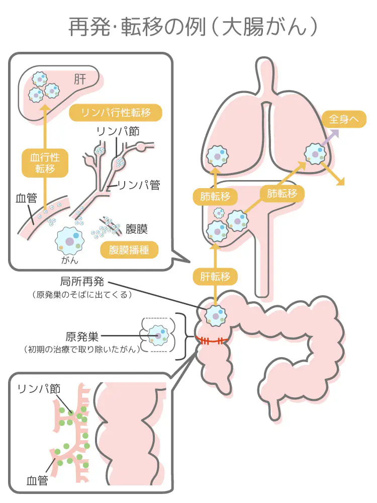 再発・転移の例（大腸がん）